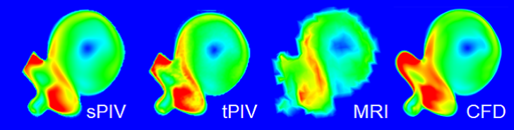 Comparing in an aneurysm model stereo and tomo PIV, MRI and CFD