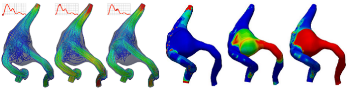 Hemodynamics in a fusiform intracranial aneurysm after flow-diverter treatment